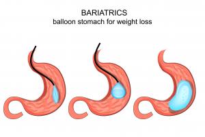 Balloon Gastric Bypass